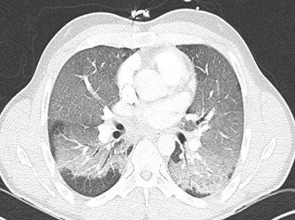 CT lung slice showing lung disease in the posterior portions of the left and right lungs